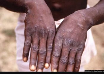 OBSH shpall sërish linë e majmunëve si emergjencë globale për shëndetin publik