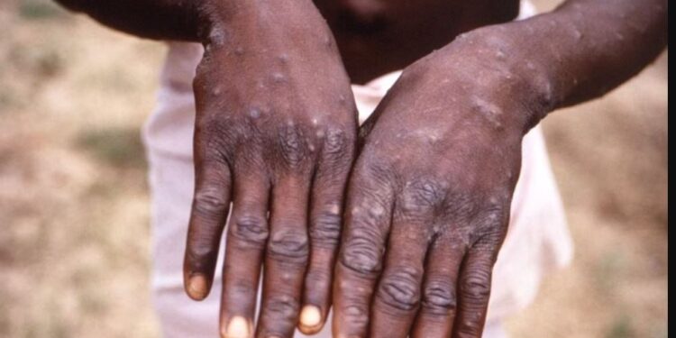 OBSH shpall sërish linë e majmunëve si emergjencë globale për shëndetin publik