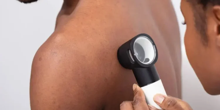 Shpiket pajisja që zbulon kancerin e lëkurës, ja si do të funksionojë