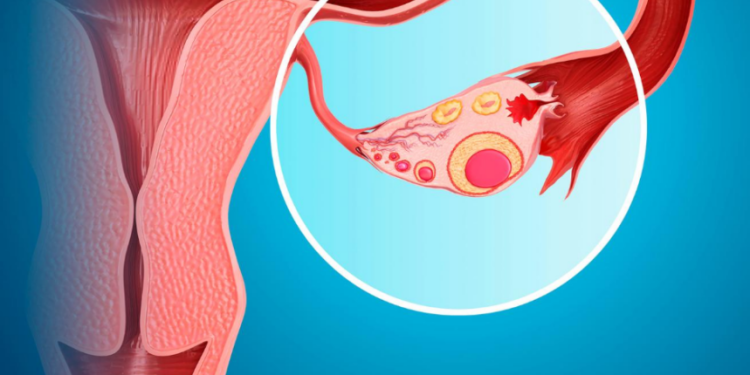Shkencëtarët britanik po zhvillojnë vaksinën e parë kundër kancerit të vezoreve?