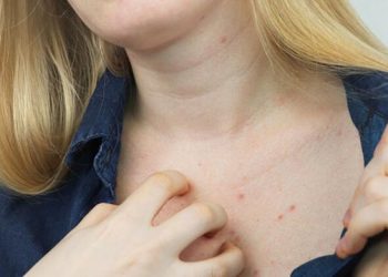 Shpërthen zgjebja në Shqipëri, mutacioni i ri kap më të pastrit. Dermatologia tregon çfarë e mbyt parazitin