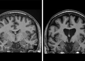 Përparim historik në mjekësi: Mjekët në Londër trajtojnë me sukses një nga sëmundjet më të rënda