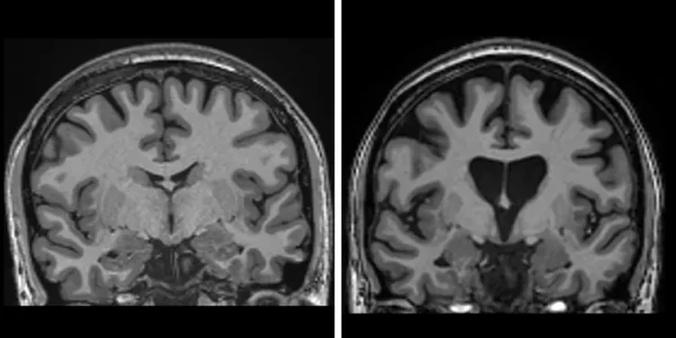 Përparim historik në mjekësi: Mjekët në Londër trajtojnë me sukses një nga sëmundjet më të rënda