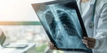 OBSH ngre alarmin: Tuberkulozi, sëmundja infektive më vdekjeprurëse në botë, shkaktoi 1.2 milion vdekje vetëm në vitin 2024 