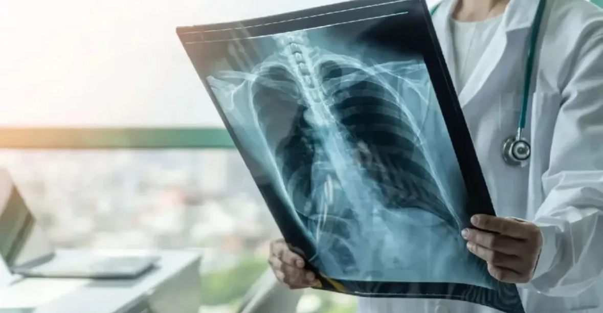 OBSH ngre alarmin  Tuberkulozi  sëmundja infektive më vdekjeprurëse në botë  shkaktoi 1 2 milion vdekje vetëm në vitin 2024