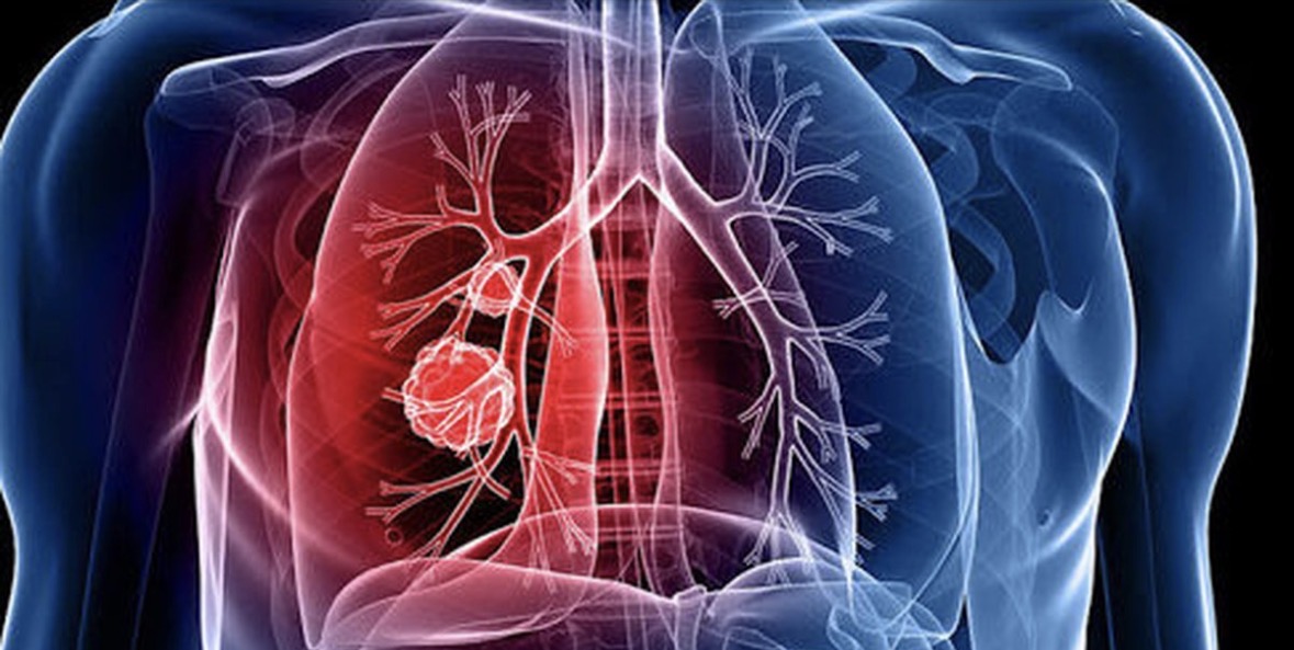 Raporti i OBSH  Tuberkulozi kërcënim serioz në Europë  1 në 5 raste nuk raportohet